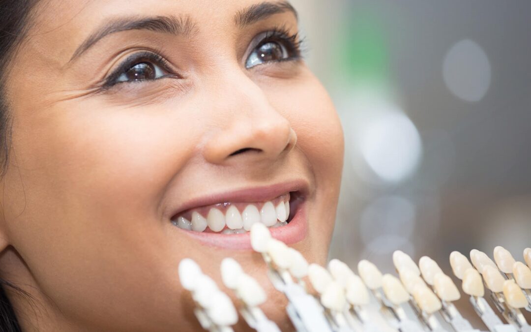 5 Things to Consider Before Getting Porcelain Veneers